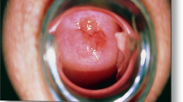 Cancer col de l uterus